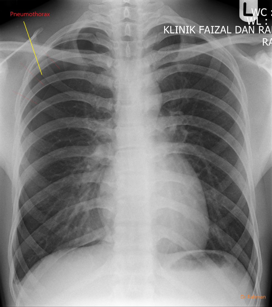 Pneumothorax Collection Of Plain X Rays